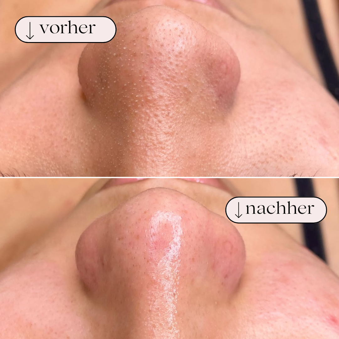 Hydrodermabrasion Porenreiniger – Wasserstoff- und Sauerstoffreinigung