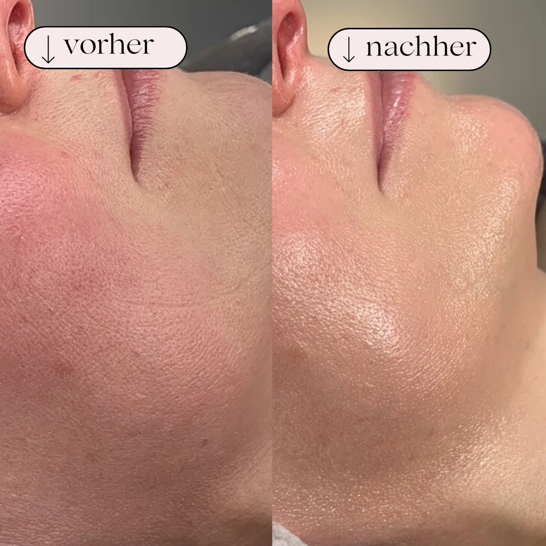 Hydrodermabrasion Porenreiniger – Wasserstoff- und Sauerstoffreinigung